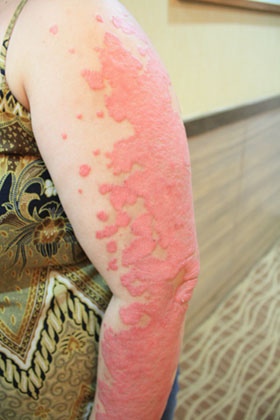 Here's the difference between nummular eczema and psoriasis