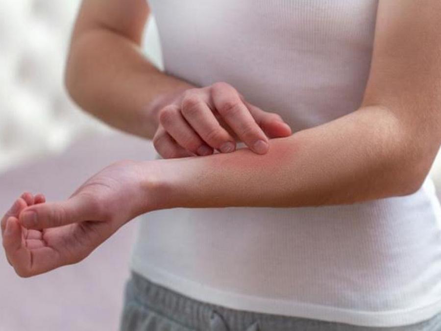 Pinoy MD' scratches the surface of eczema