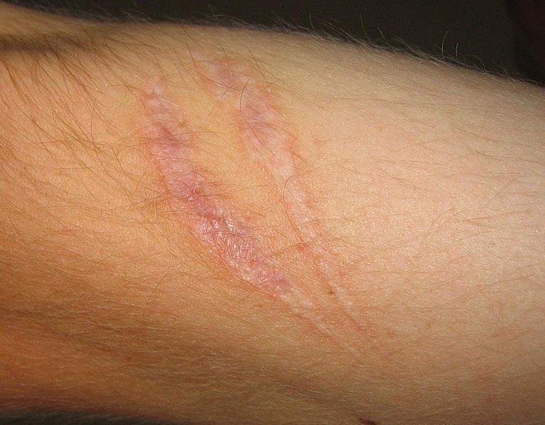 Can nasty scars be removed?