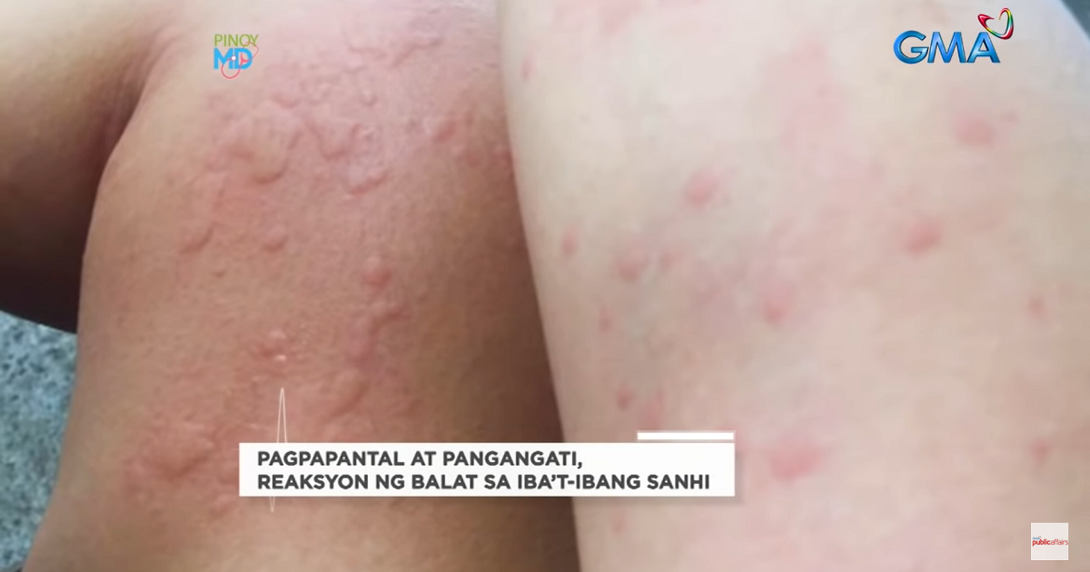 What causes inflammation of the skin? Dermatologist explains