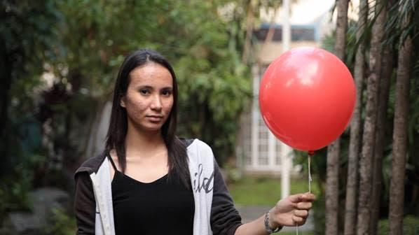Usapang acne, tampok sa 'Pinoy MD'