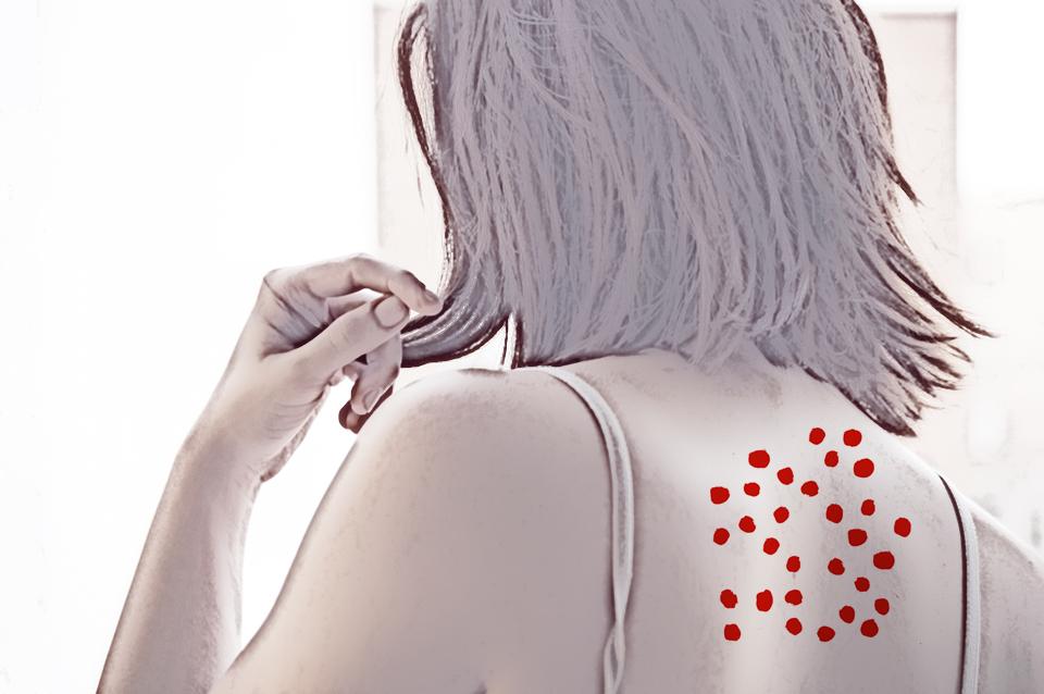 What causes back acne or 'bacne' and what you can do about it