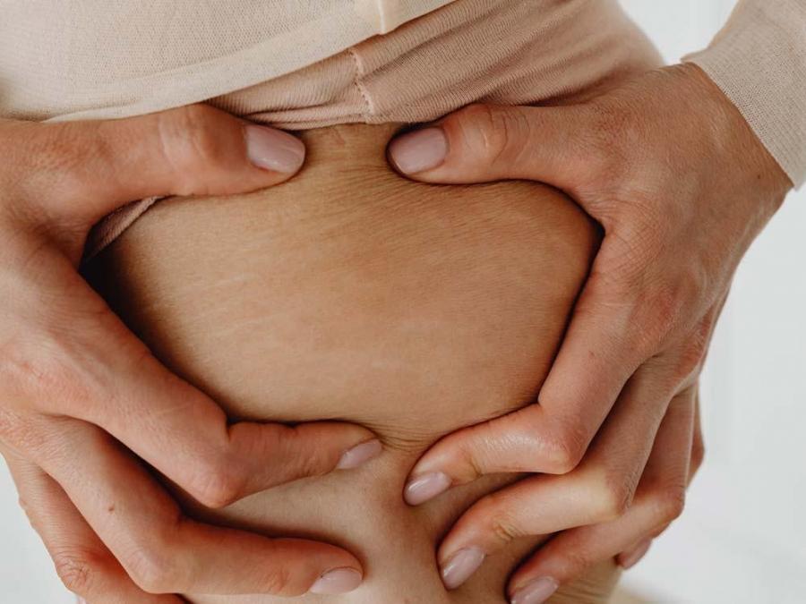 Ask Dr. Jean: Don't stress over stretch marks