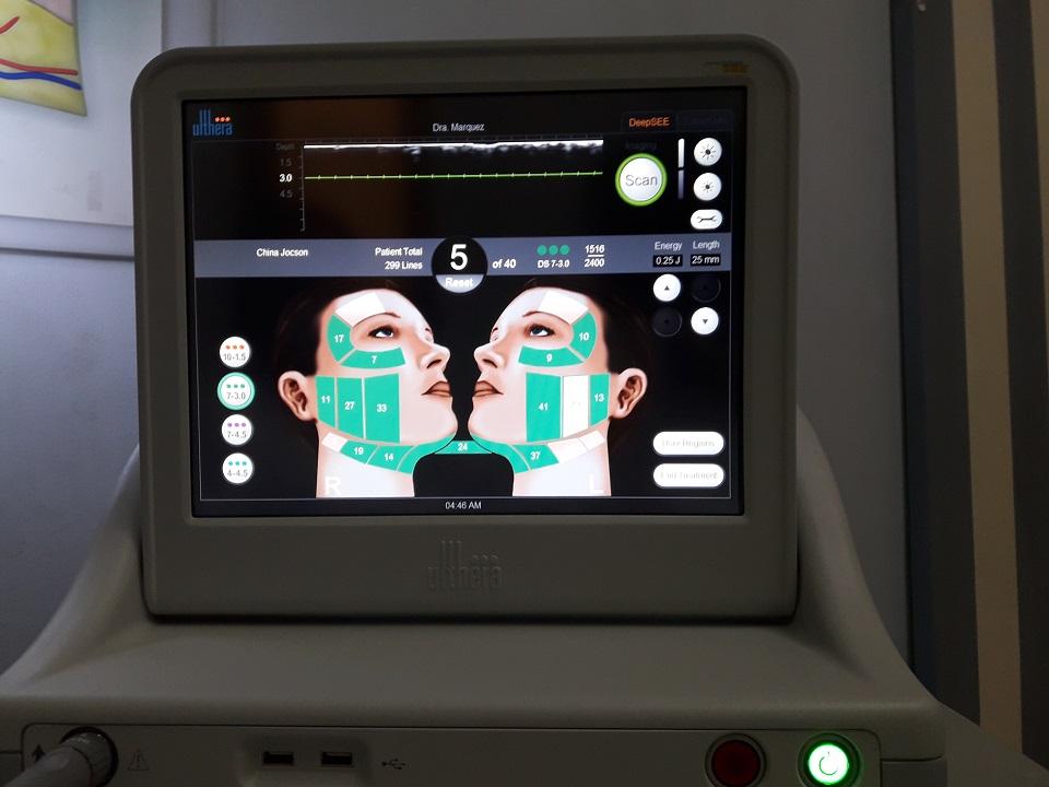 No going under the knife: Treatment uses ultrasound to lift, tighten skin