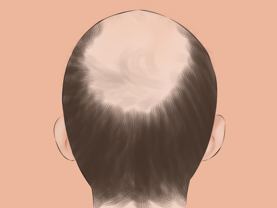 Alopecia: What are its causes and symptoms? Can it be treated and cured?