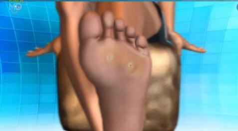 Persistent warts on your feet? Your immune system might be weak