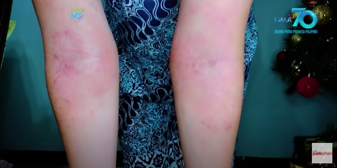 What is dyshidrotic eczema and what can you do about it?