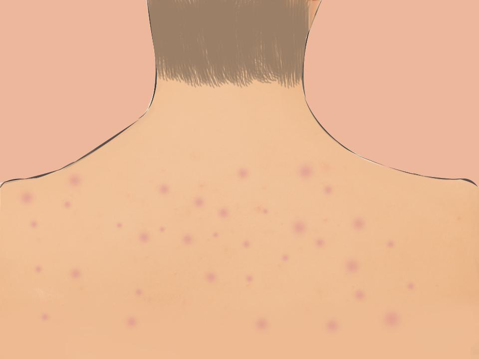 Why is prickly heat — aka 'bungang araw' — so prevalent in the summer?