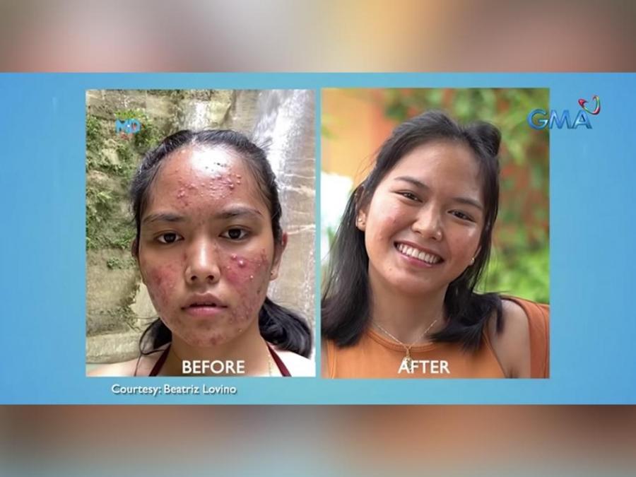 How did this content creator get rid of cystic acne?