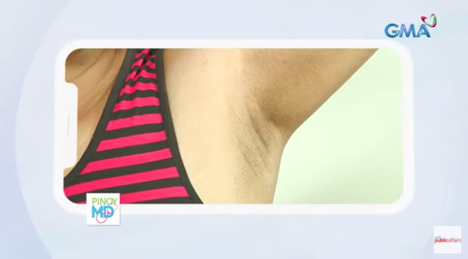 Chicken skin in your underarms? Here’s how you can prevent it